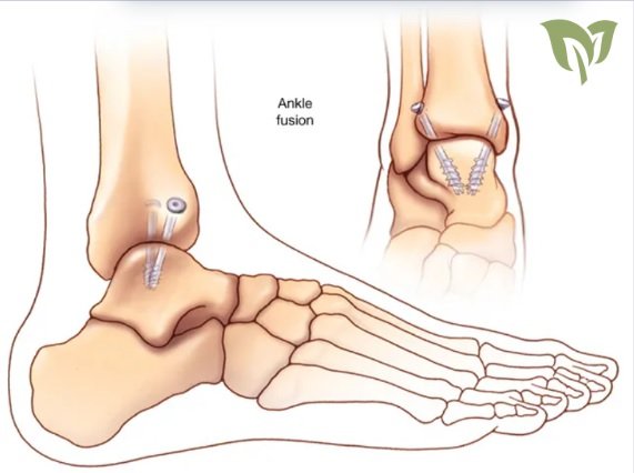 Types of WellHealthOrganic Surgeries for Wrist and Ankle