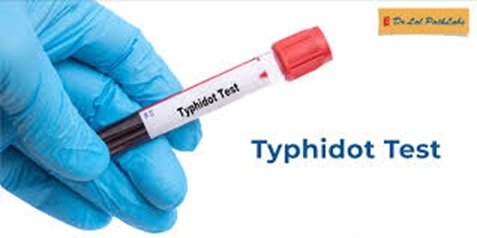 Typhoid Test