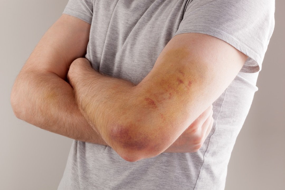 Hemophilia Disease