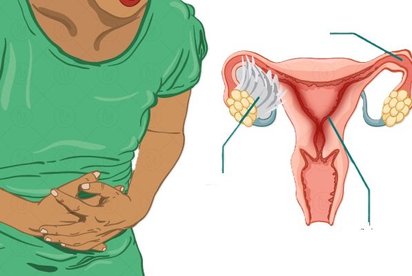 Pelvic Inflammatory Disease PPT